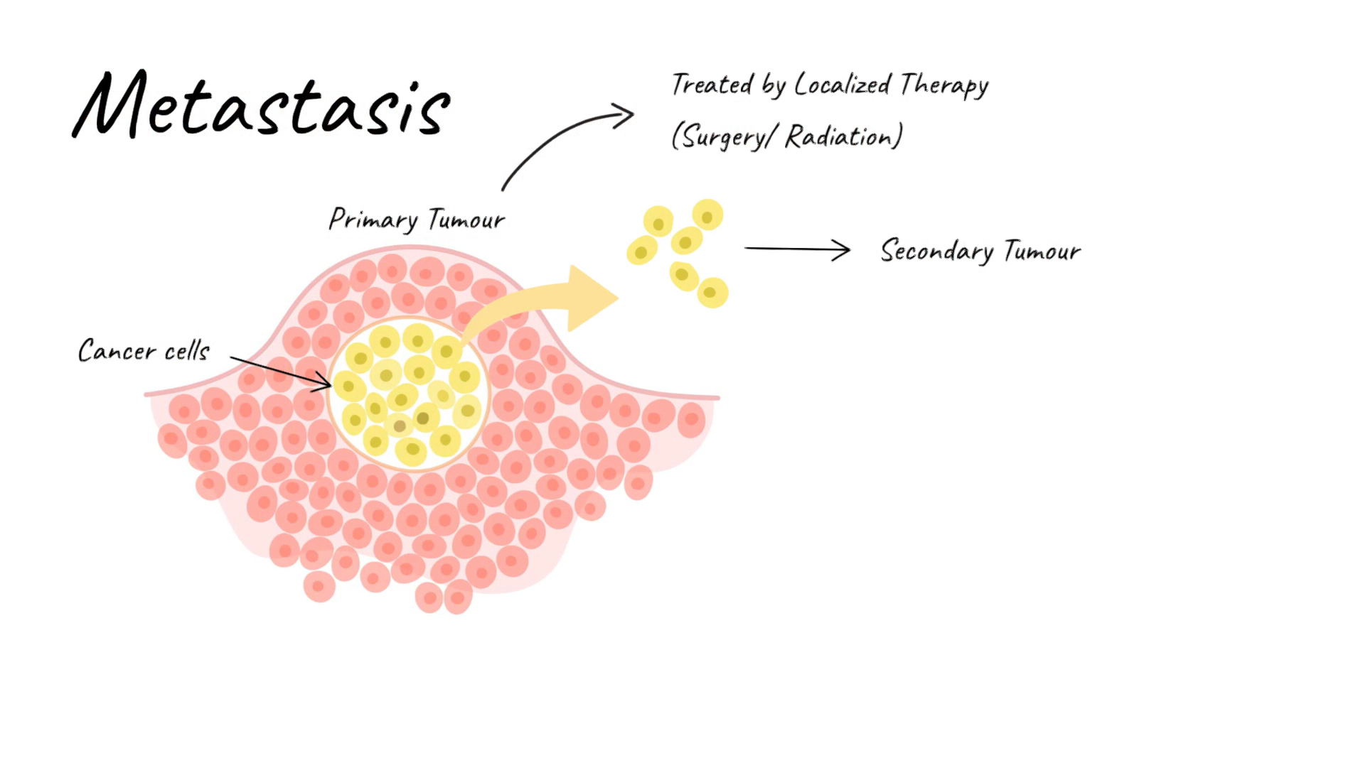 How does Cancer Spread?