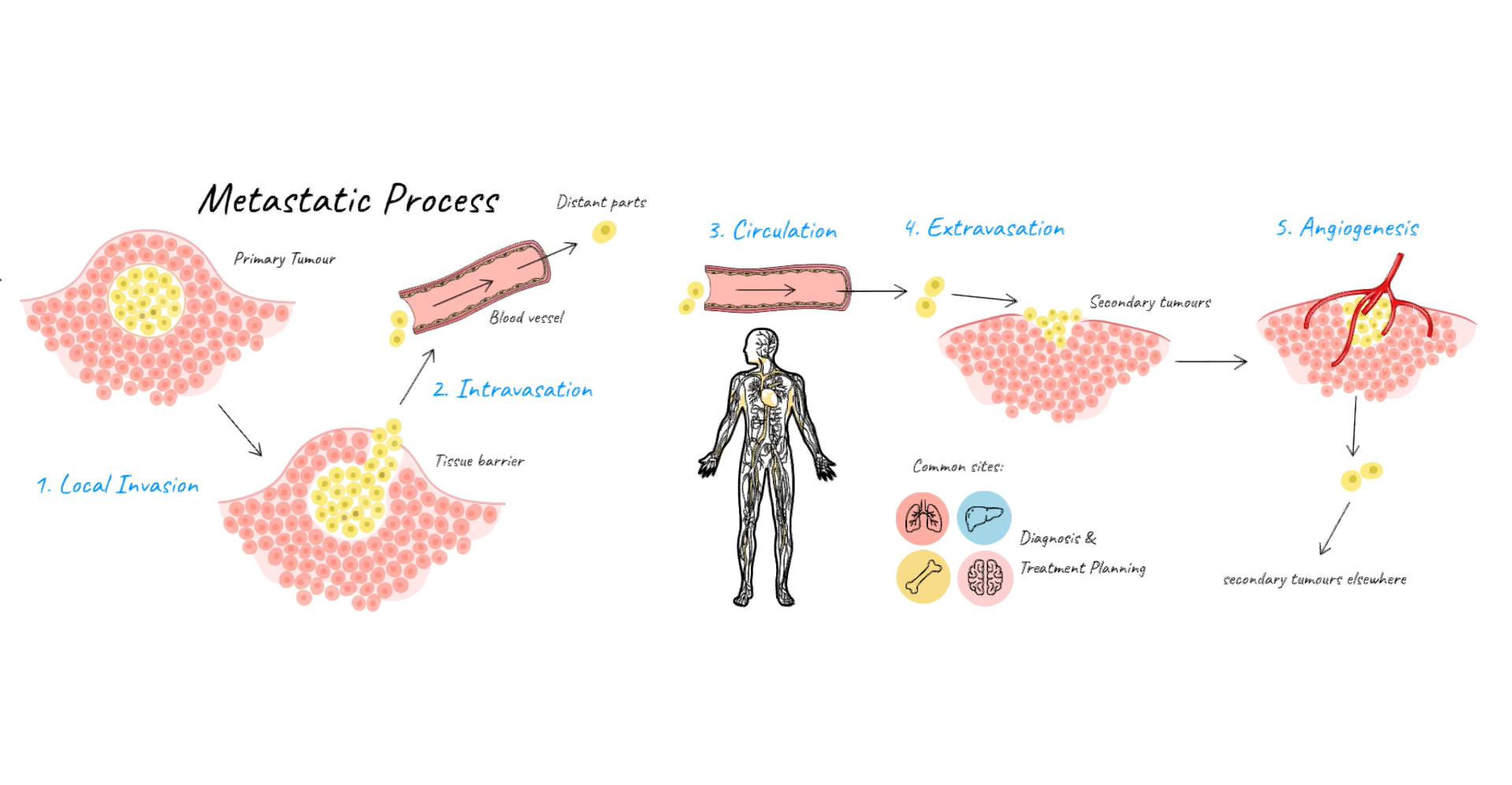 How does Cancer Spread?